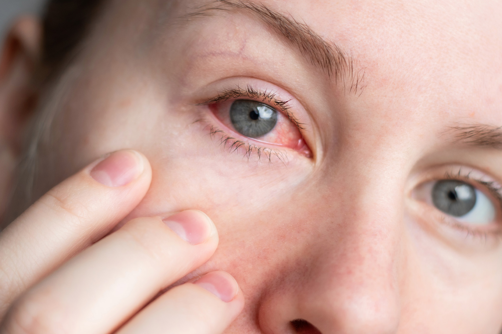 Dry Eyes vs. Allergies: How to Tell the Difference