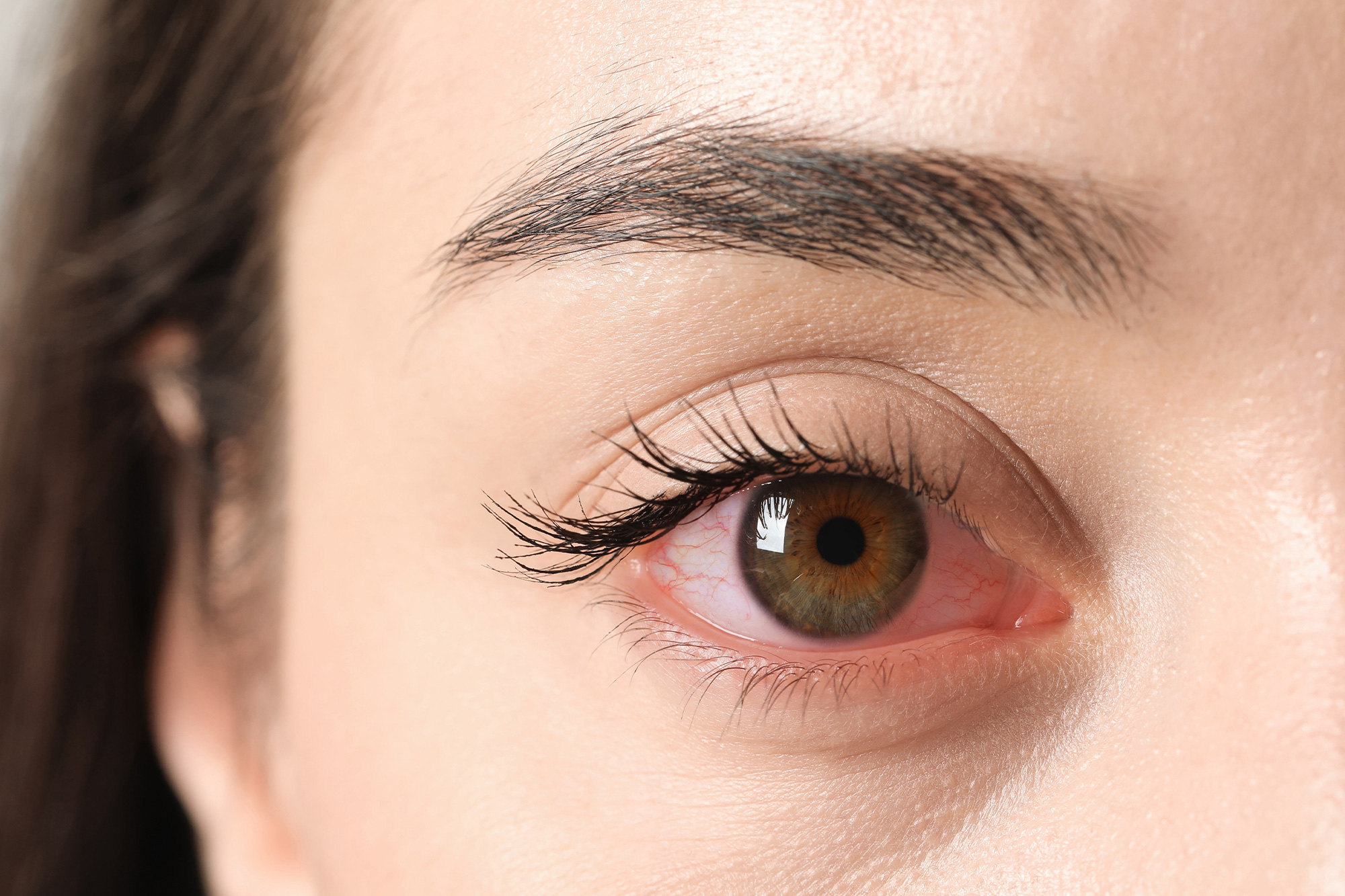 What Is Posterior Vitreous Detachment (PVD)?