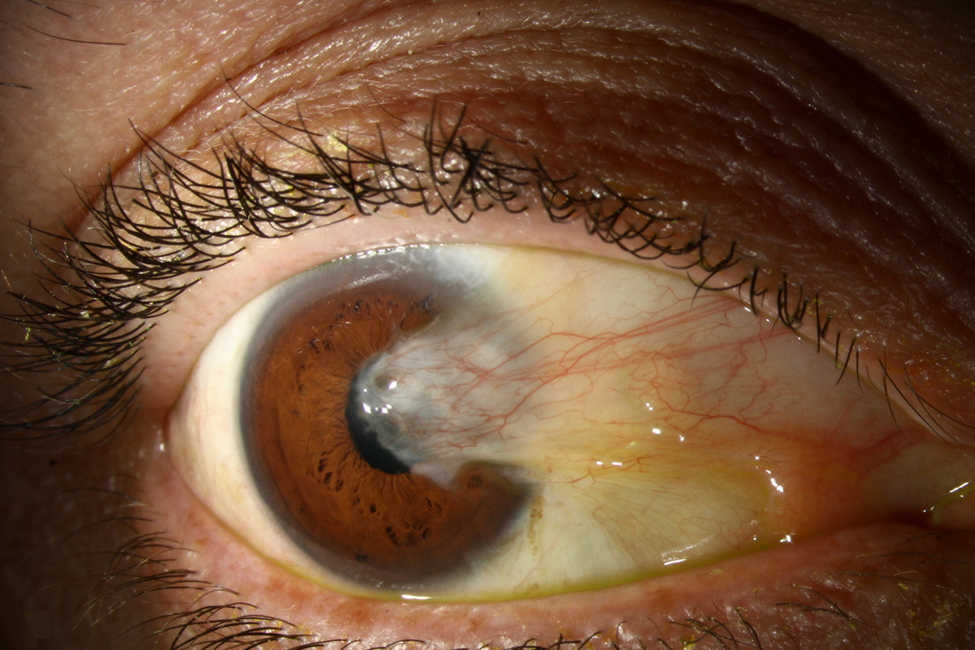 What Is a Pterygium and When Does It Need Surgery?