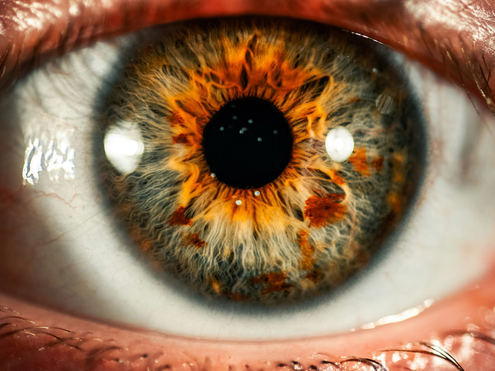 EVO ICL vs. LASIK in 2026: A Boca Raton Ophthalmologist's Side-by-Side Guide
