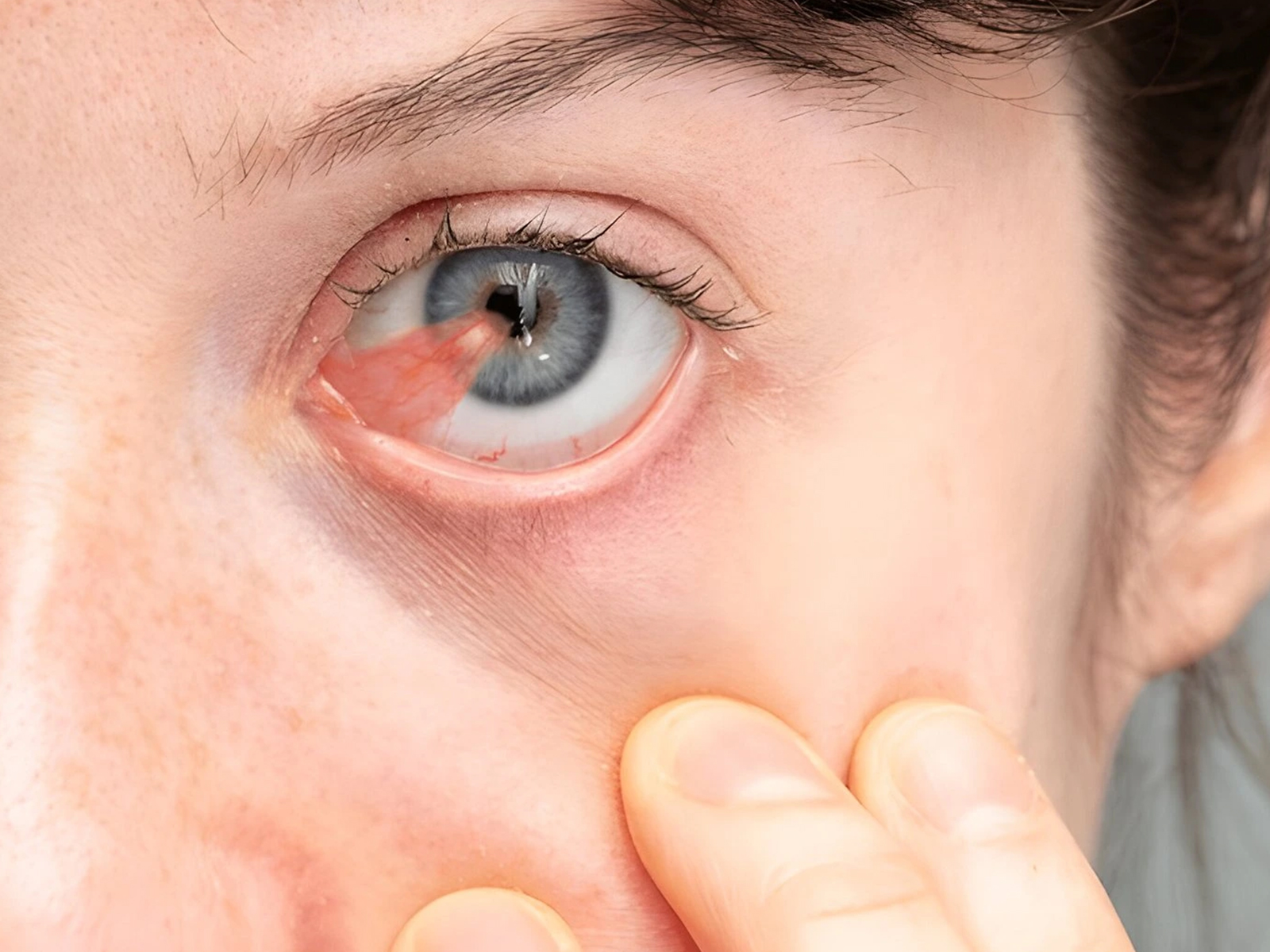 Pterygium (Surfer's Eye) in South Florida: A Boca Raton Ophthalmologist's Guide to Causes, Treatment, and Surgery