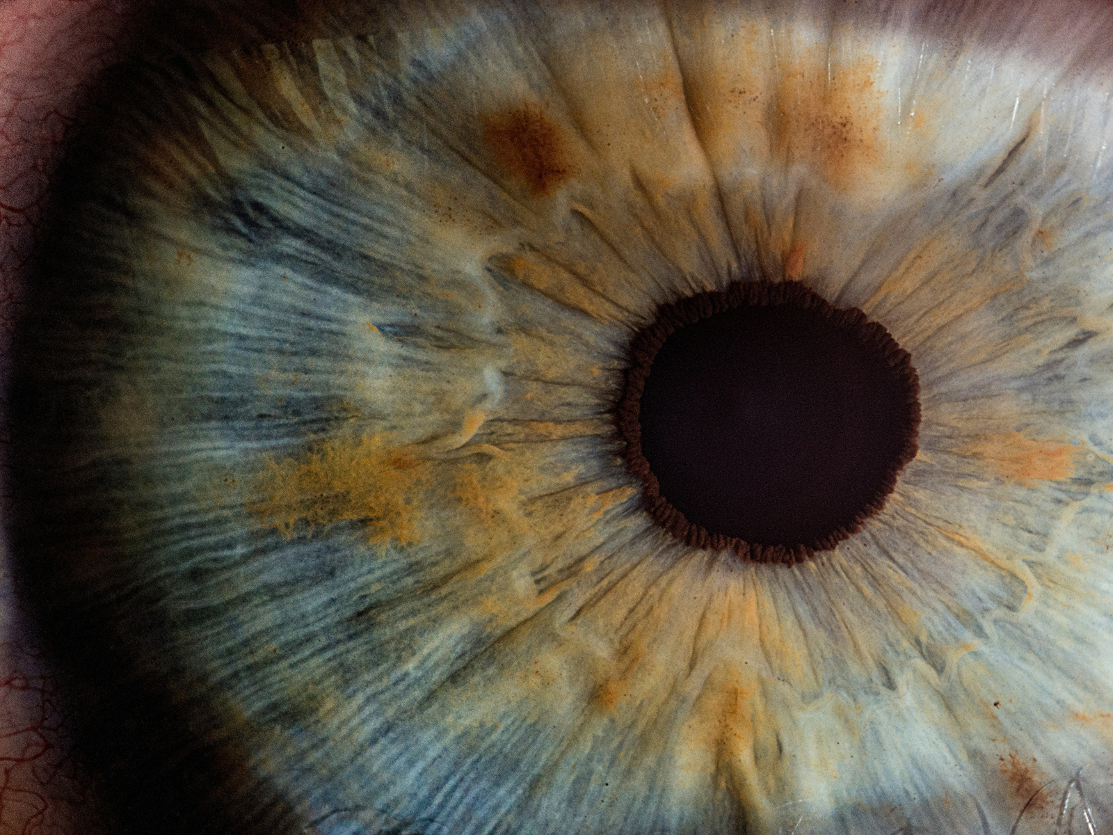 Wet vs. Dry Macular Degeneration: A Boca Raton Retina Guide to Diagnosis, Treatment, and Anti-VEGF Injections
