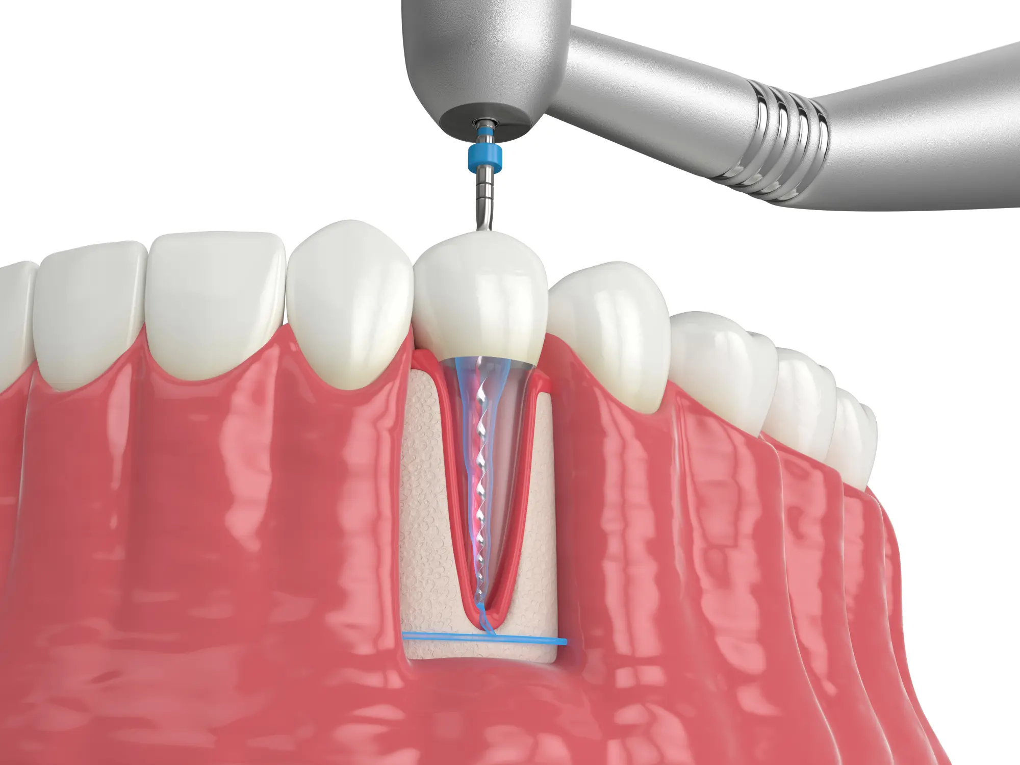 Scaling and Root Planing: When a Routine Cleaning Isn’t Enough