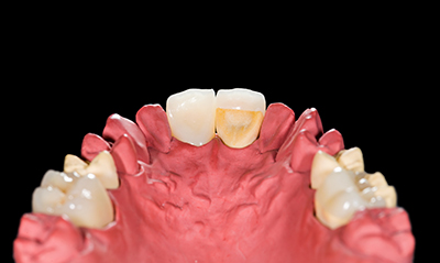 Dental Crowns