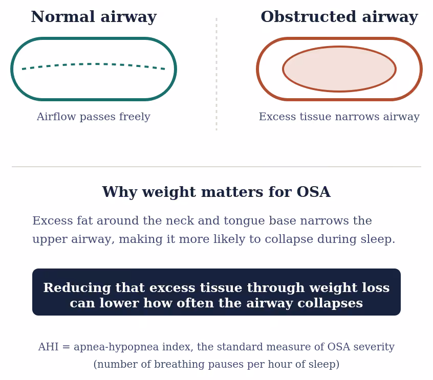 Fig. 1 — Simplified schematic: why excess weight around the upper airway contributes to OSA.