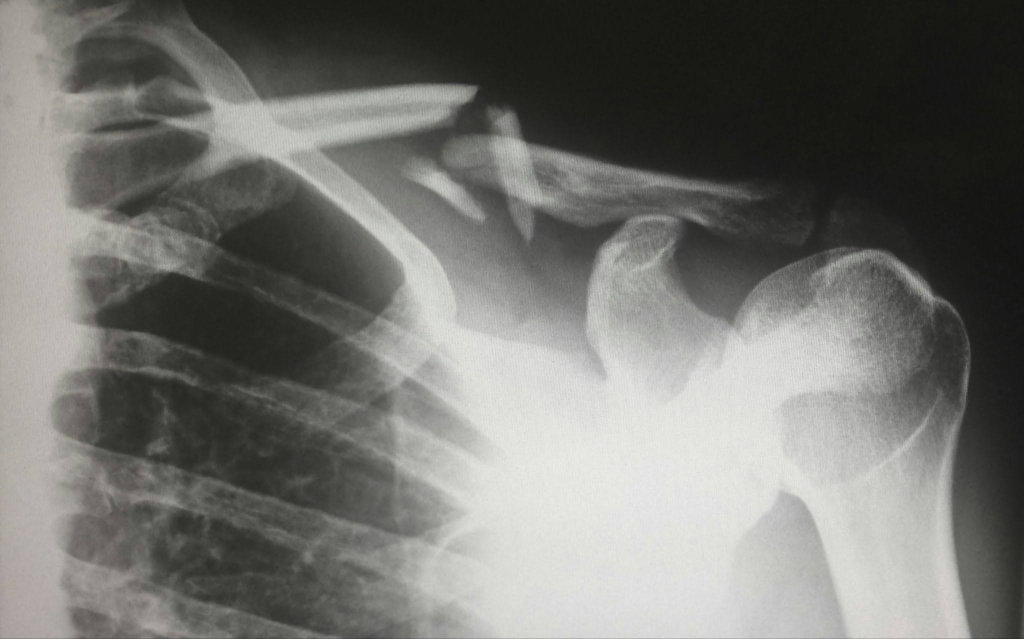 X-ray of broken collarbone