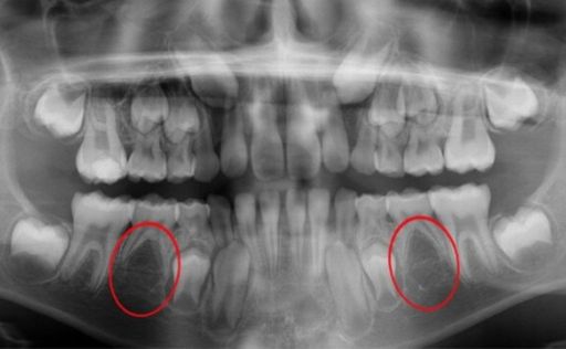 Agenesia dental radiografia