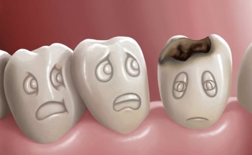Caries en dientes definitivos