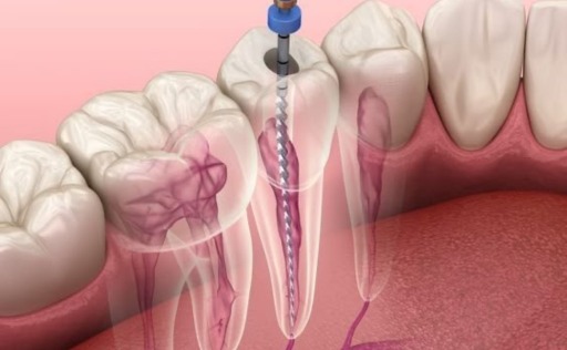  ¿Por qué es importante hacer una endodoncia y salvar tu diente?