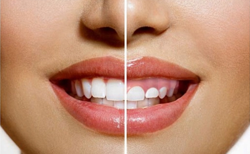 Qué es la gingivectomía y por qué puede ayudarte a recuperar tu salud gingival