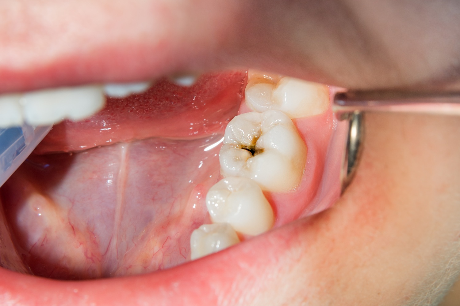 tooth and mirror tool