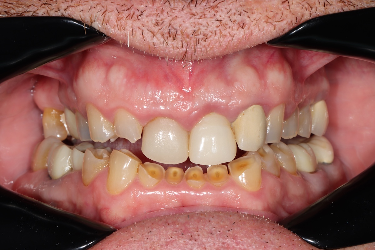 before and after treatment