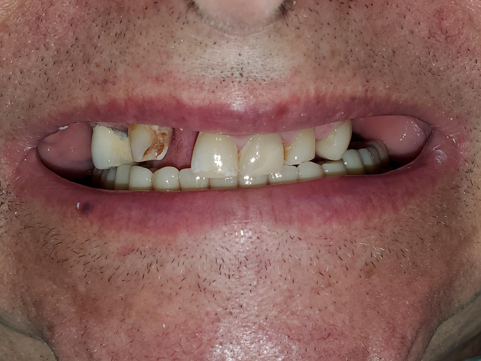 R Gaeta before treatment