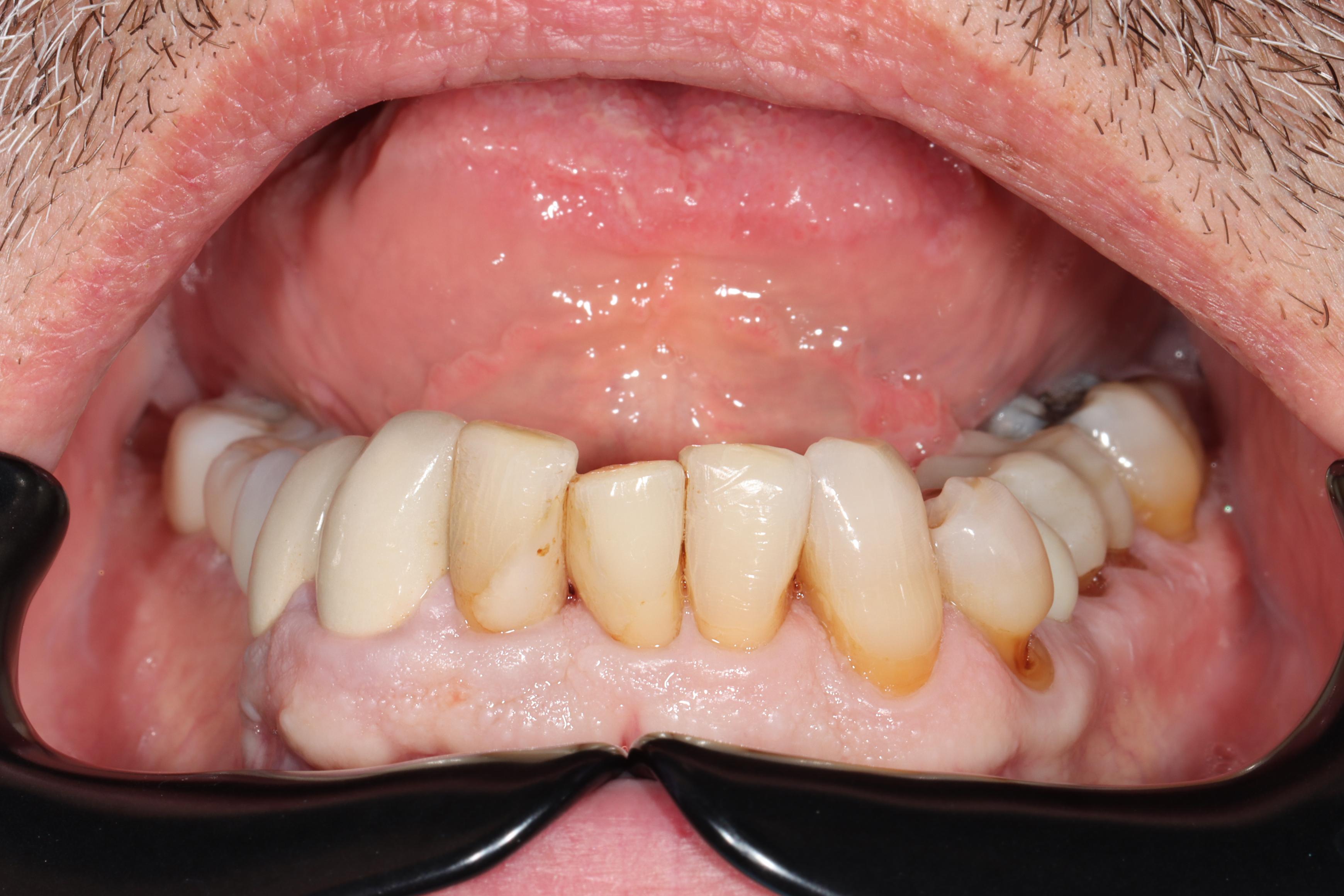 J Taf before treatment