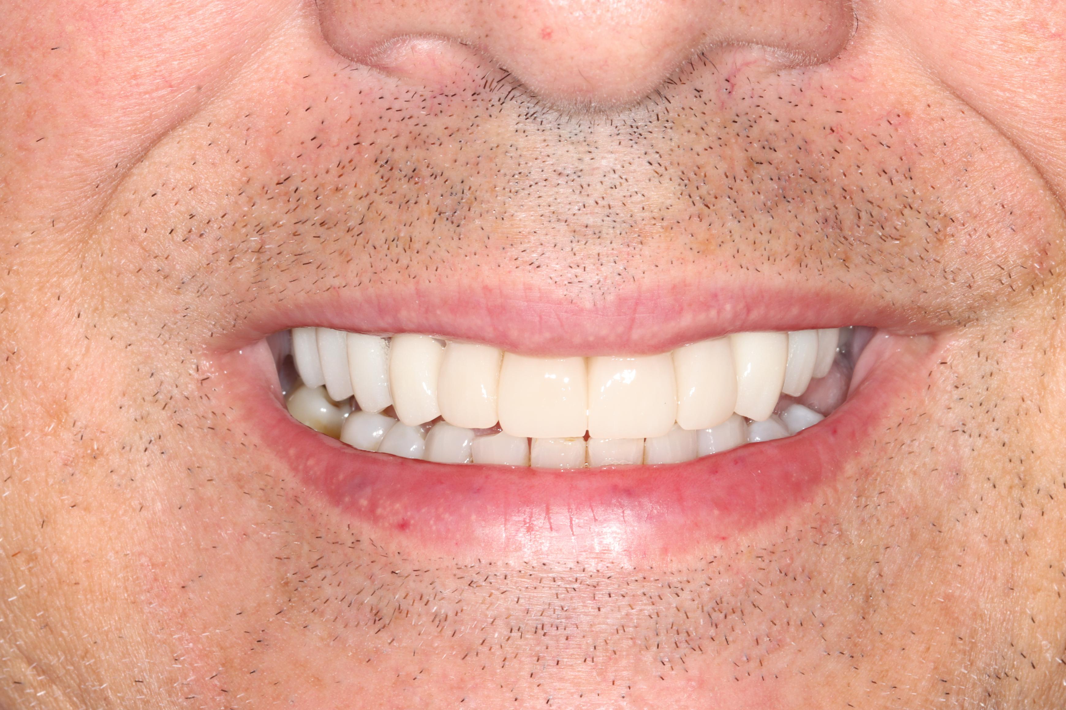 A Paz after treatment