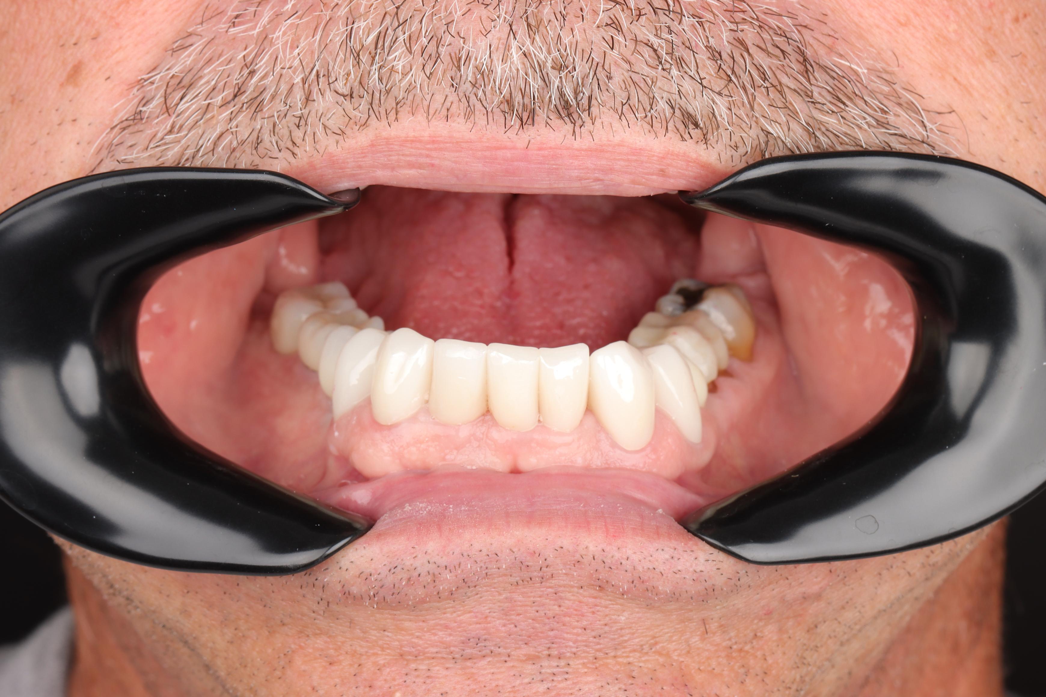 J Taf after treatment