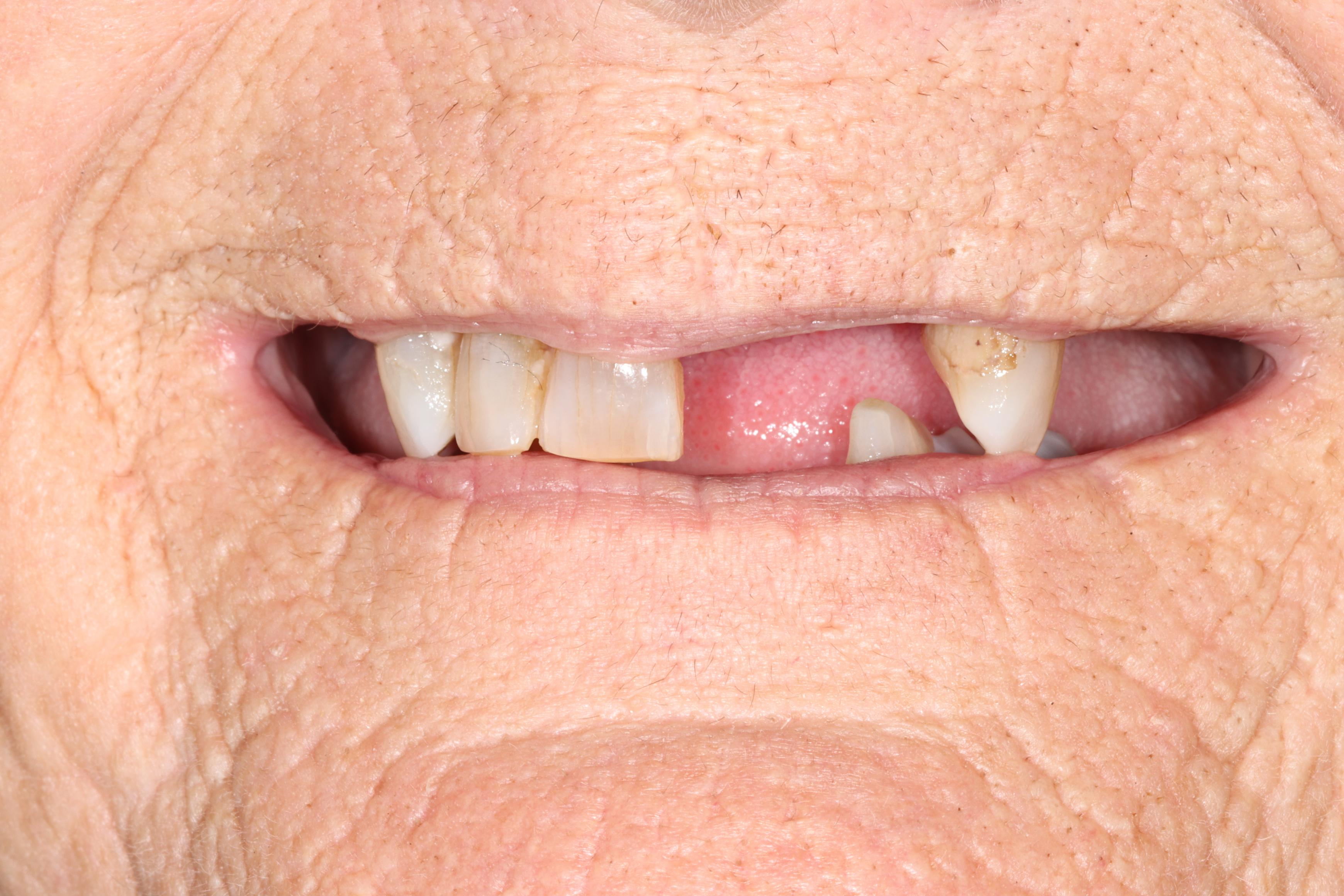 J Roach before treatment