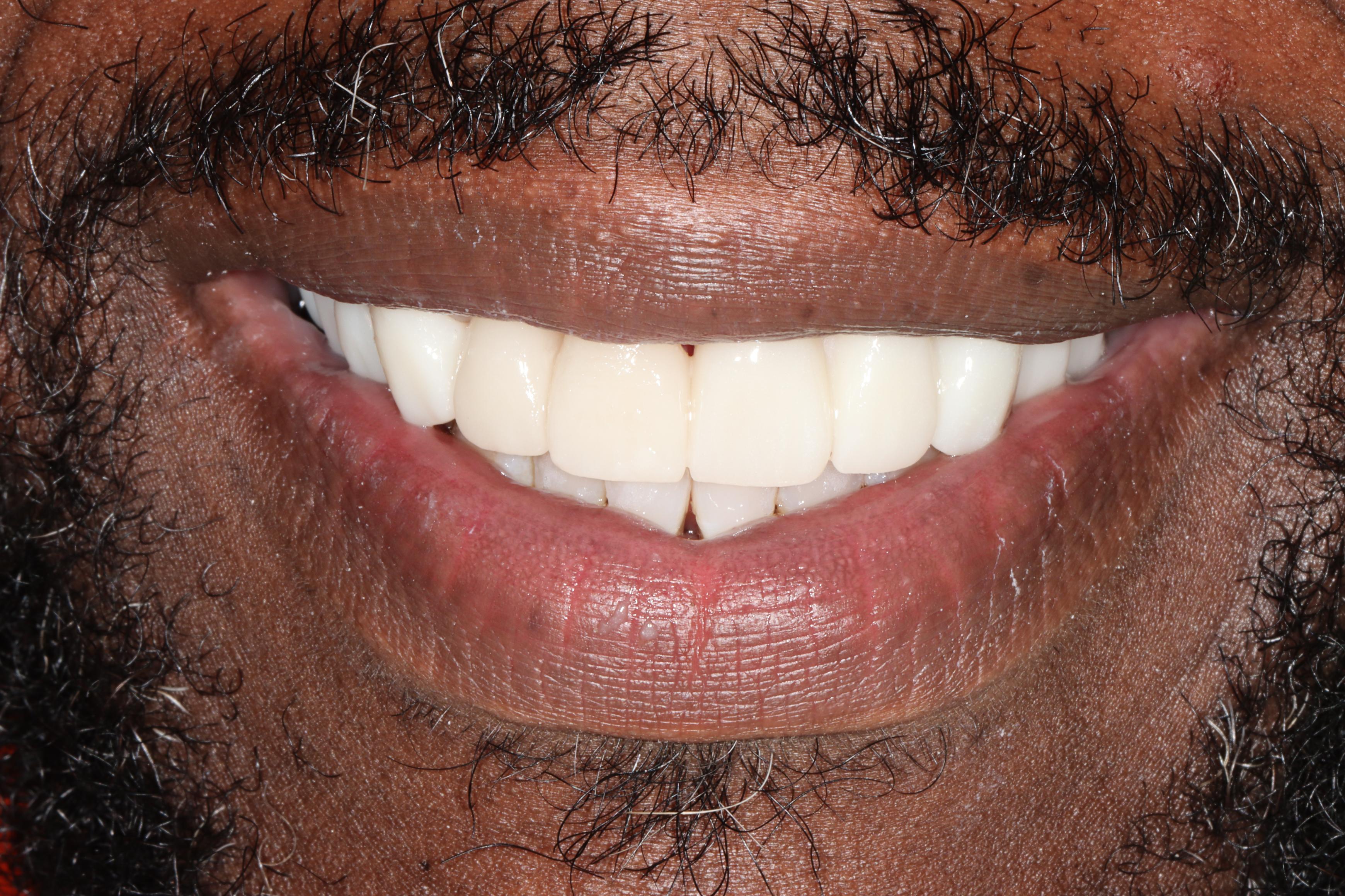 M Bryant after treatment