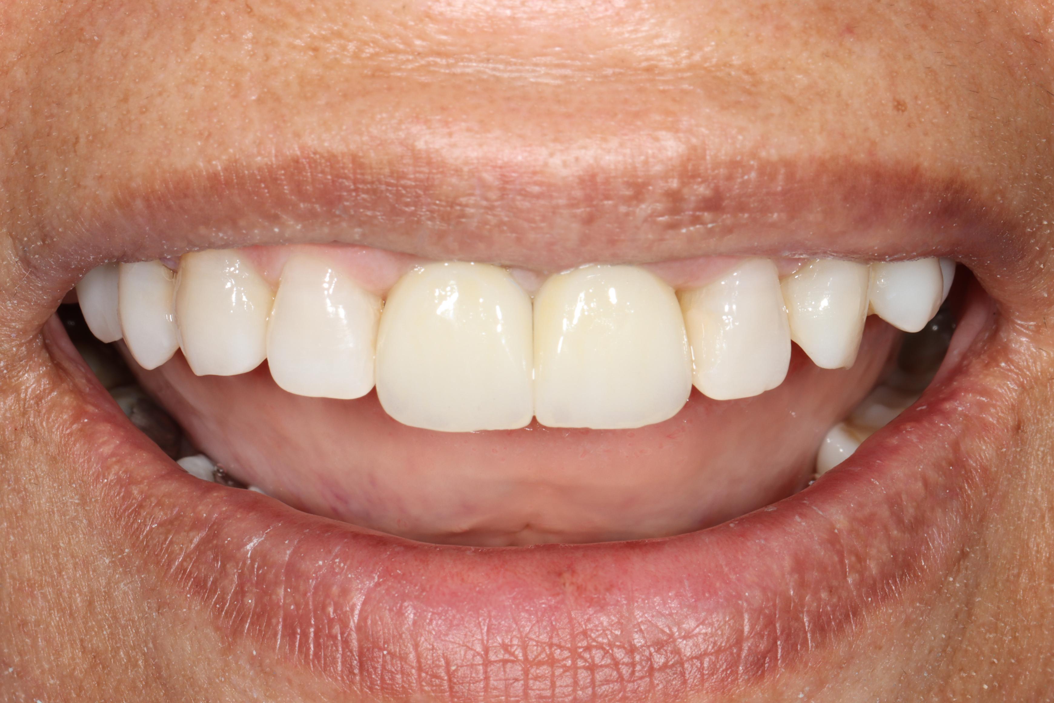 R Lab after treatment