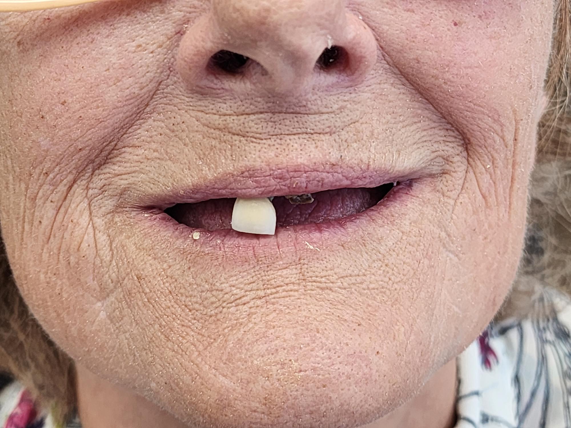 Chapman before treatment
