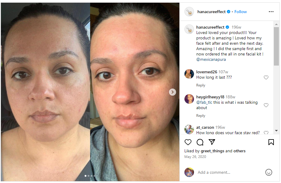 Instagram before-and-after skincare photos with customer caption describing visible results