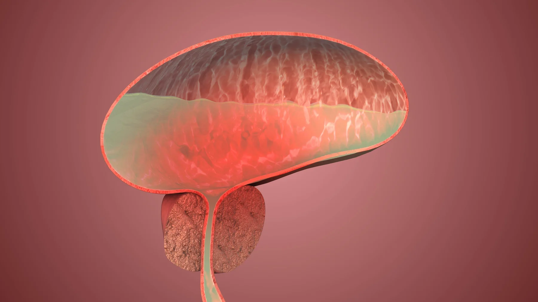 Illustration einer gutartigen Prostatavergrößerung mit Blase und Harnröhre. | GoSpring