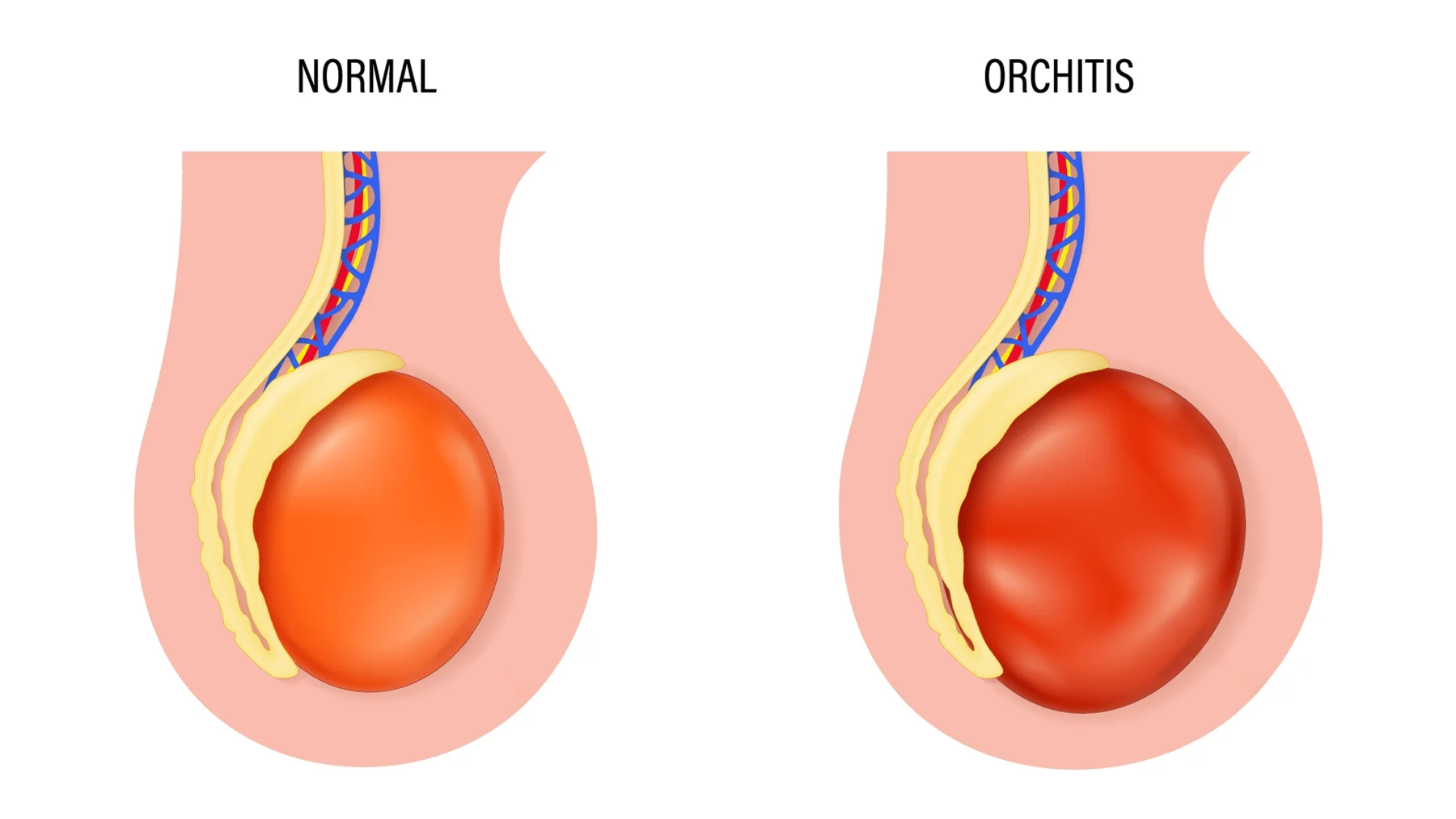 Vergleich normaler Hoden und Hodenentzündung (Orchitis) – Illustration zeigt gesunden Hoden und entzündeten, geschwollenen Hoden. | GoSpring