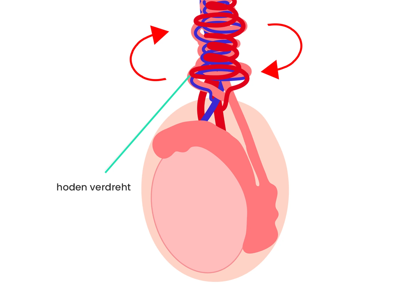 Illustration einer Hodentorsion: verdrehter Hoden mit blockierten Blutgefäßen. | GoSpring