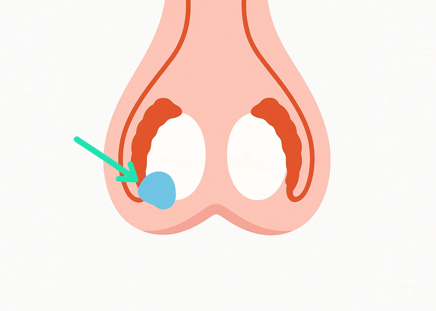 Schematische Darstellung eines Knotens am Hoden mit Pfeilmarkierung. | GoSpring