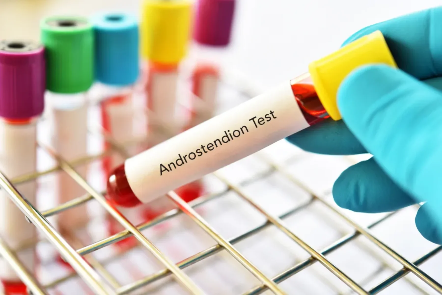 Blutprobe für Androstendion-Test im Labor – Hormonspiegel von Androstendion zur Diagnose hormoneller Störungen. | GoSpring