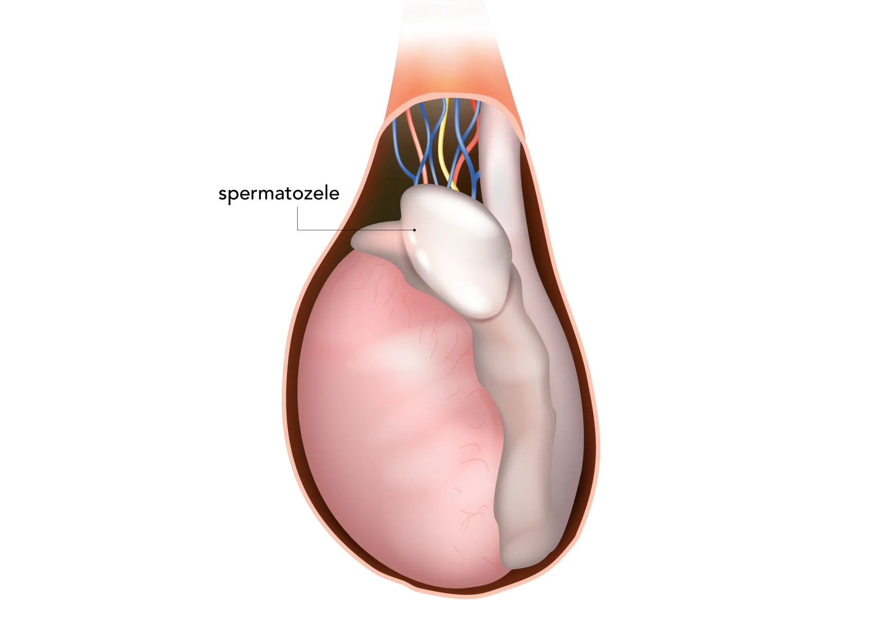 Medizinische Illustration einer Spermatozele am Nebenhoden des Mannes. | GoSpring