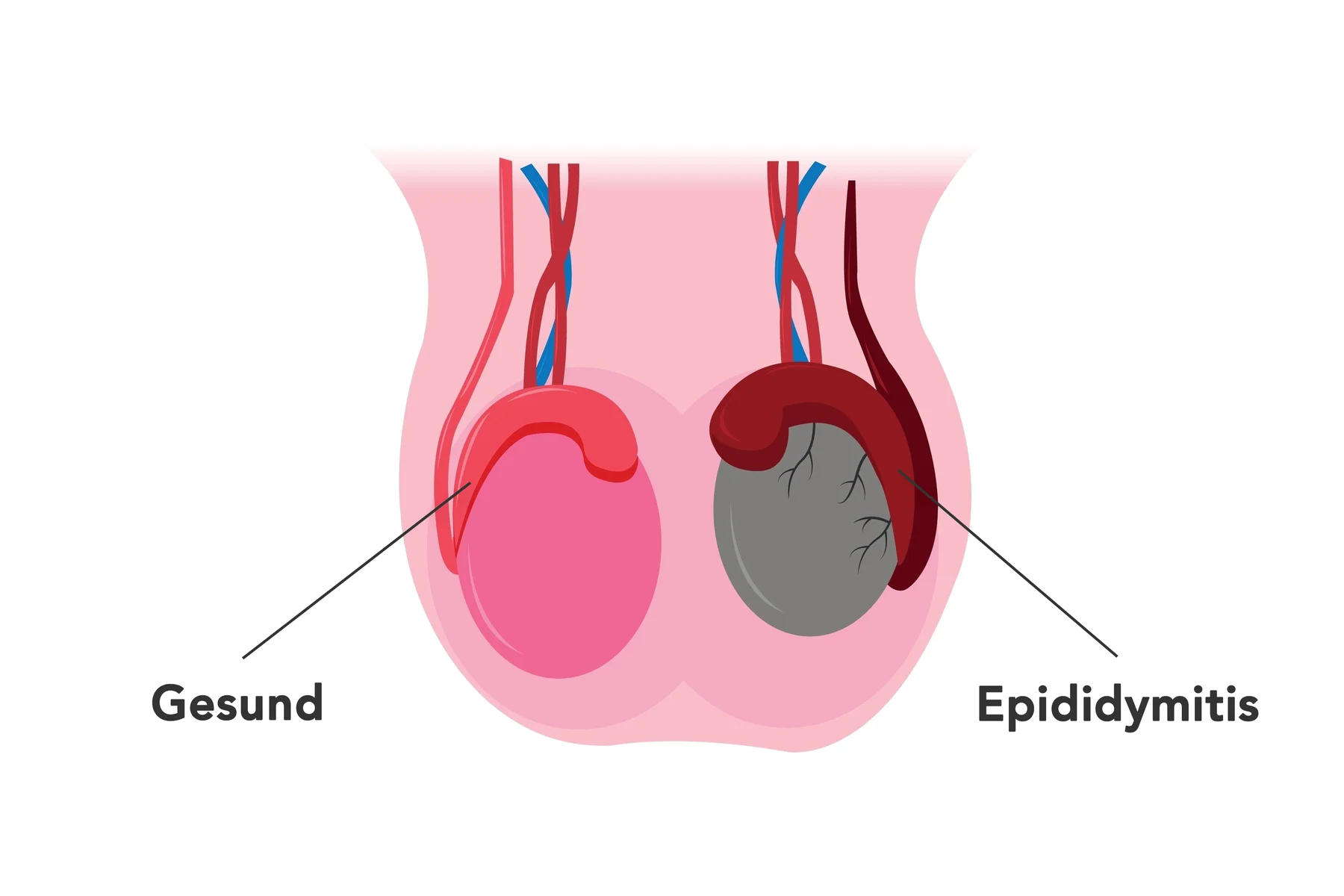 Vergleich gesunder Hoden und entzündeter Nebenhoden (Epididymitis) – Schwellung und Veränderung im Hodensack. | GoSpring