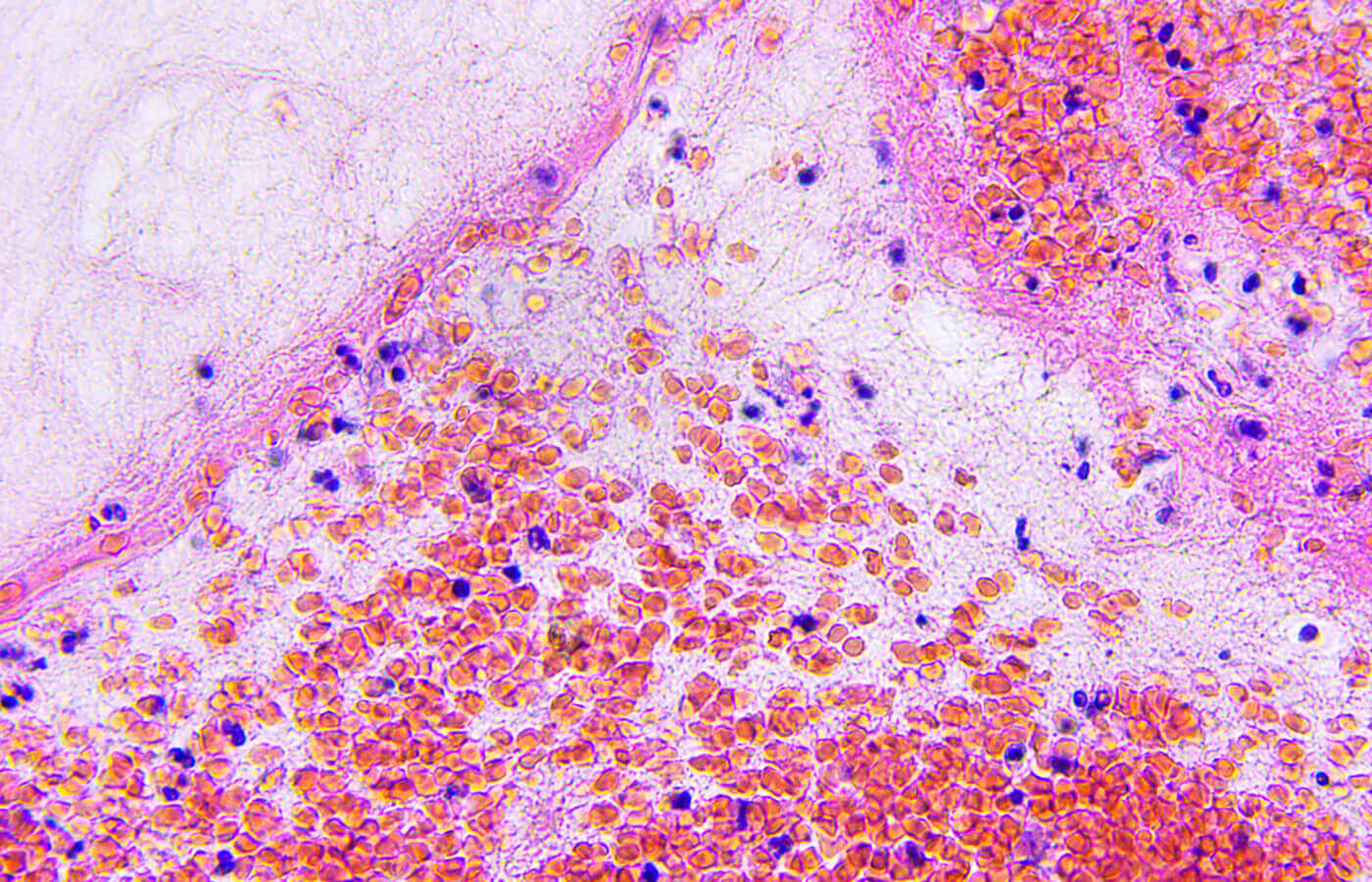 Glioblastoma
