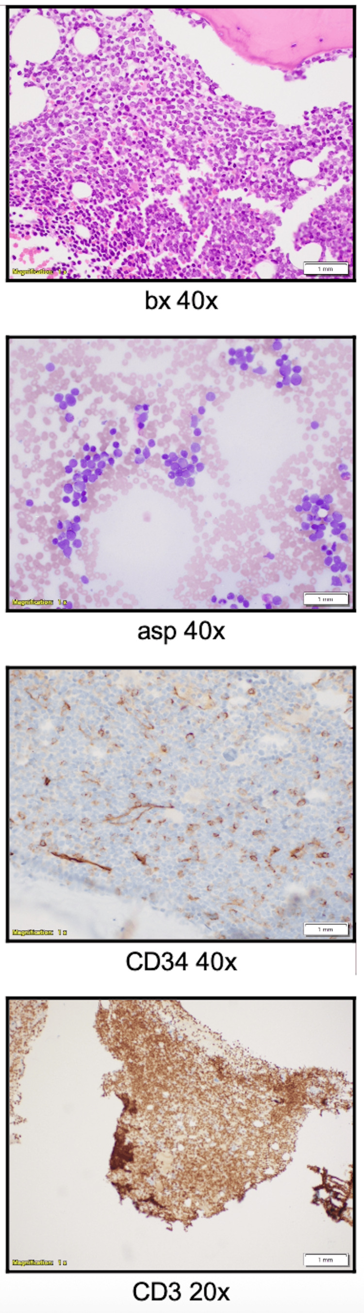 Extramedullary Involvement in T/Myeloid Mixed Phenotype Acute Leukemia With BCR::ABL1 Fusion in a Hispanic Female Patient: A Case Report