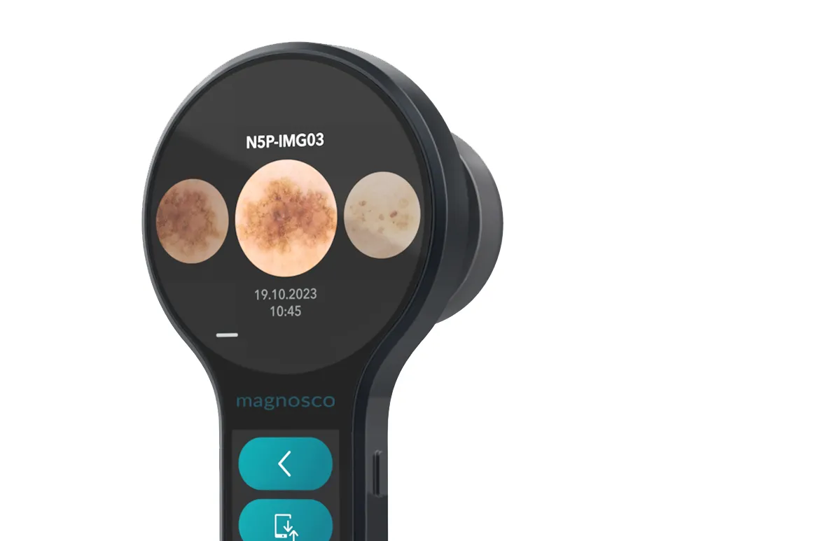 AI-supported digital dermoscopy system