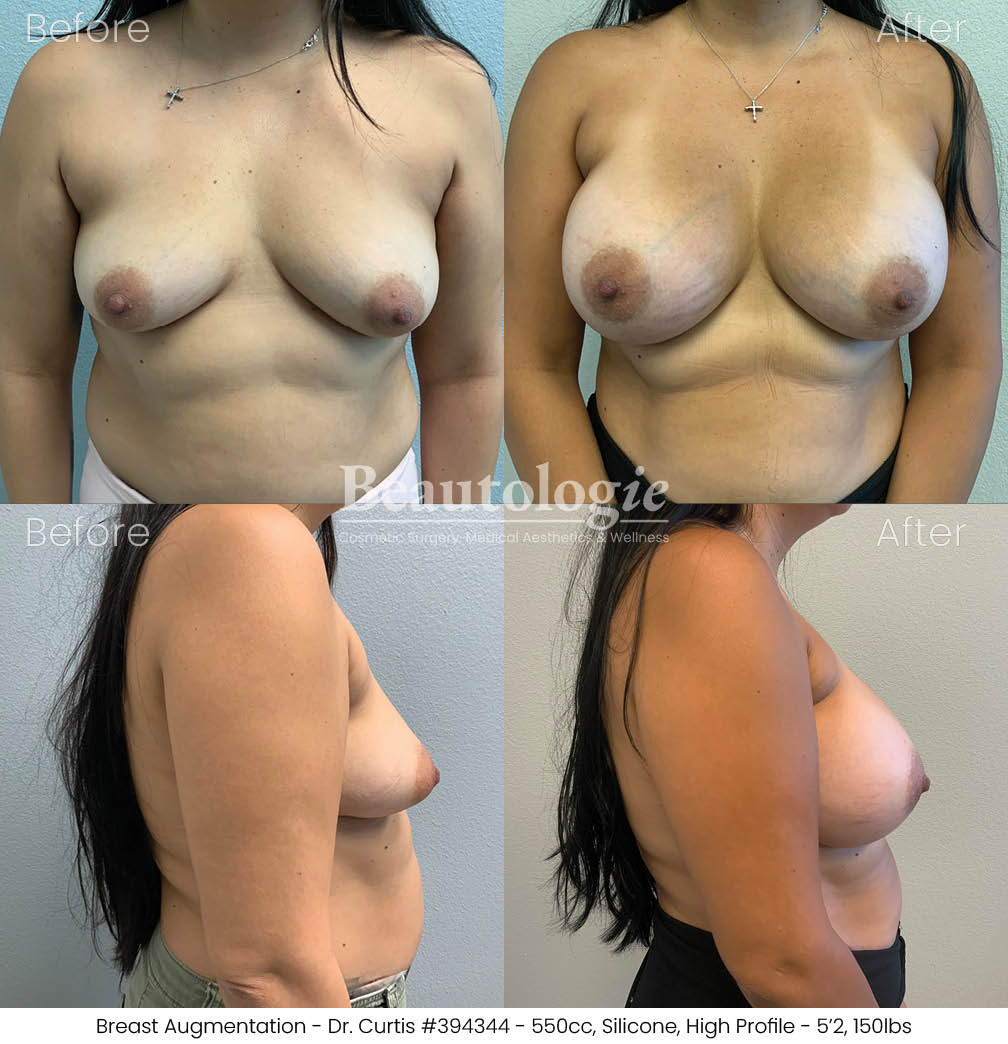 Before-and-afters-breast-breast-augmentation-dr-curtis-31