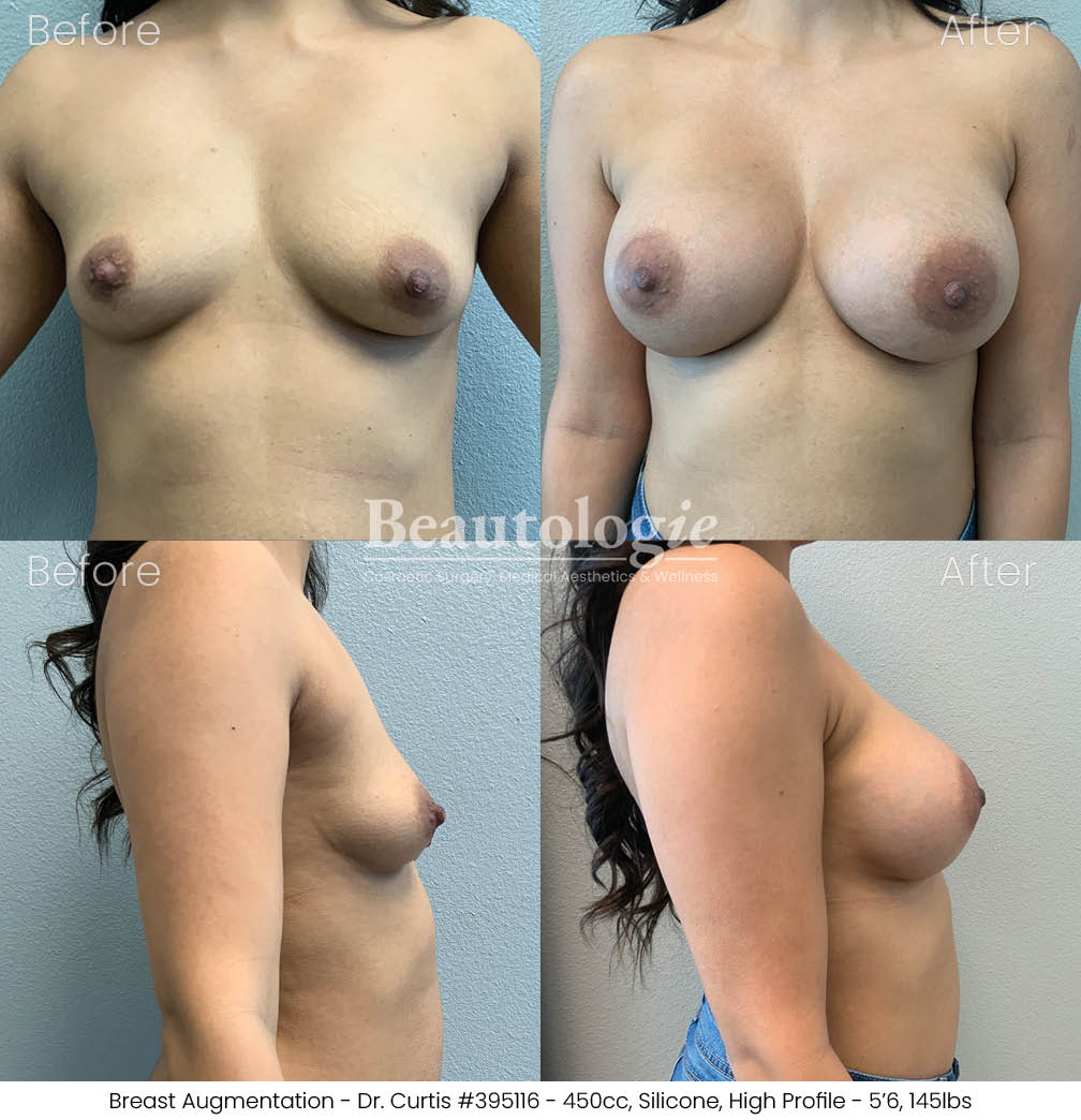 Before-and-afters-breast-breast-augmentation-dr-curtis-32