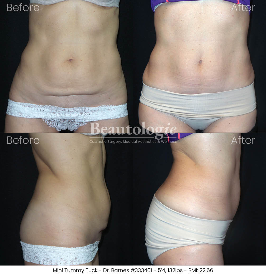 tummytuck-dr-barnes-07