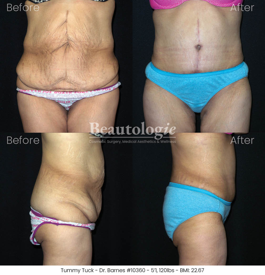 tummytuck-dr-barnes-08