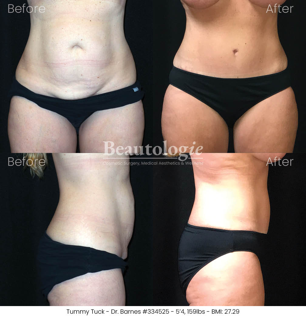 tummytuck-dr-barnes-09