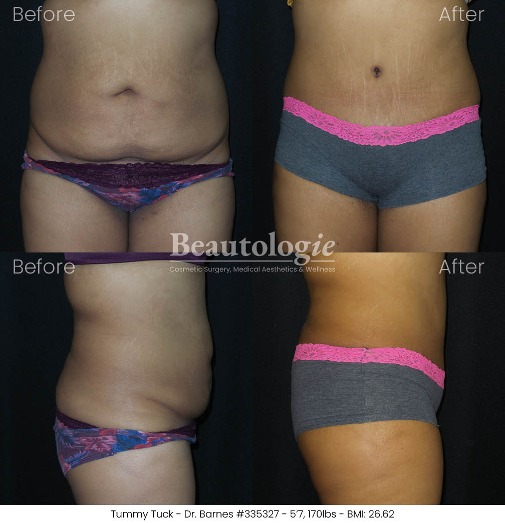 tummytuck-dr-barnes-10