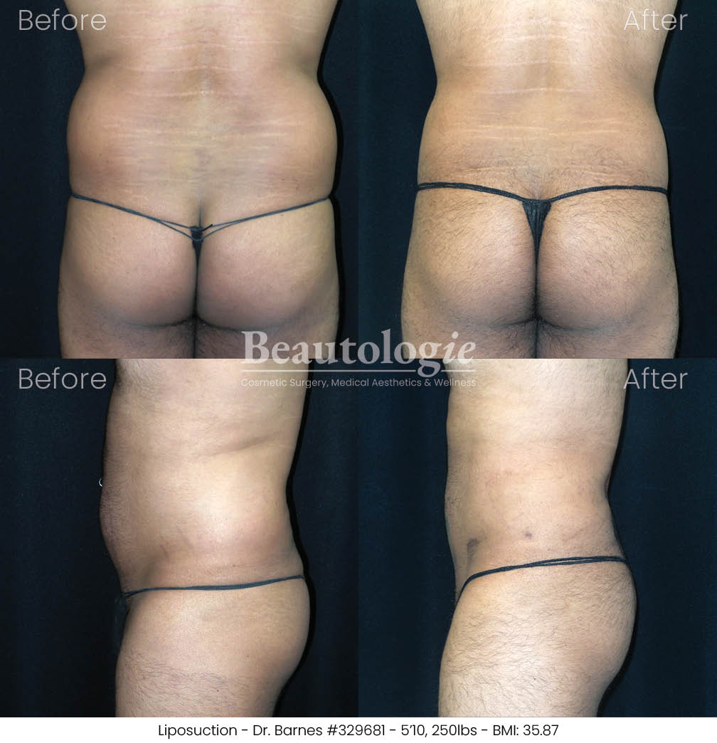 lipo-dr-barnes-02