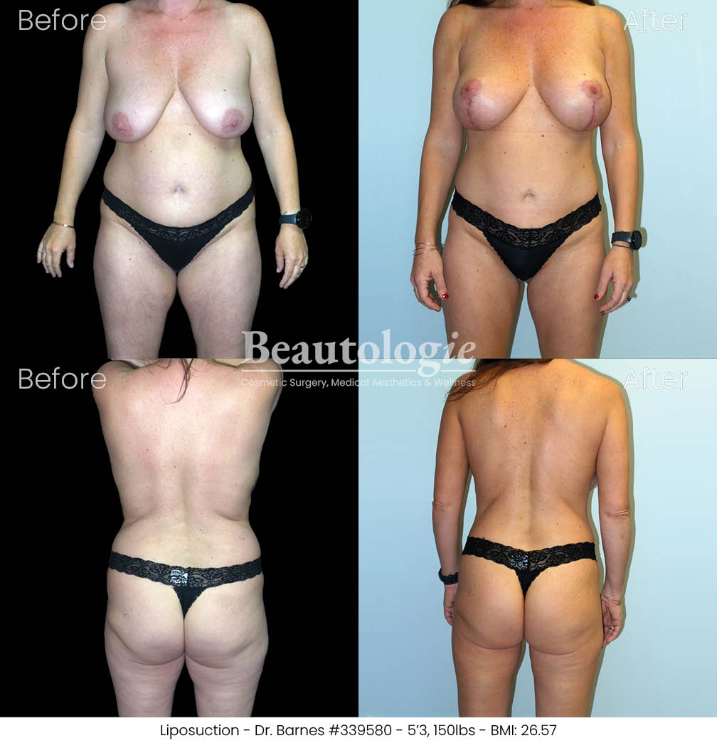 lipo-dr-barnes-03