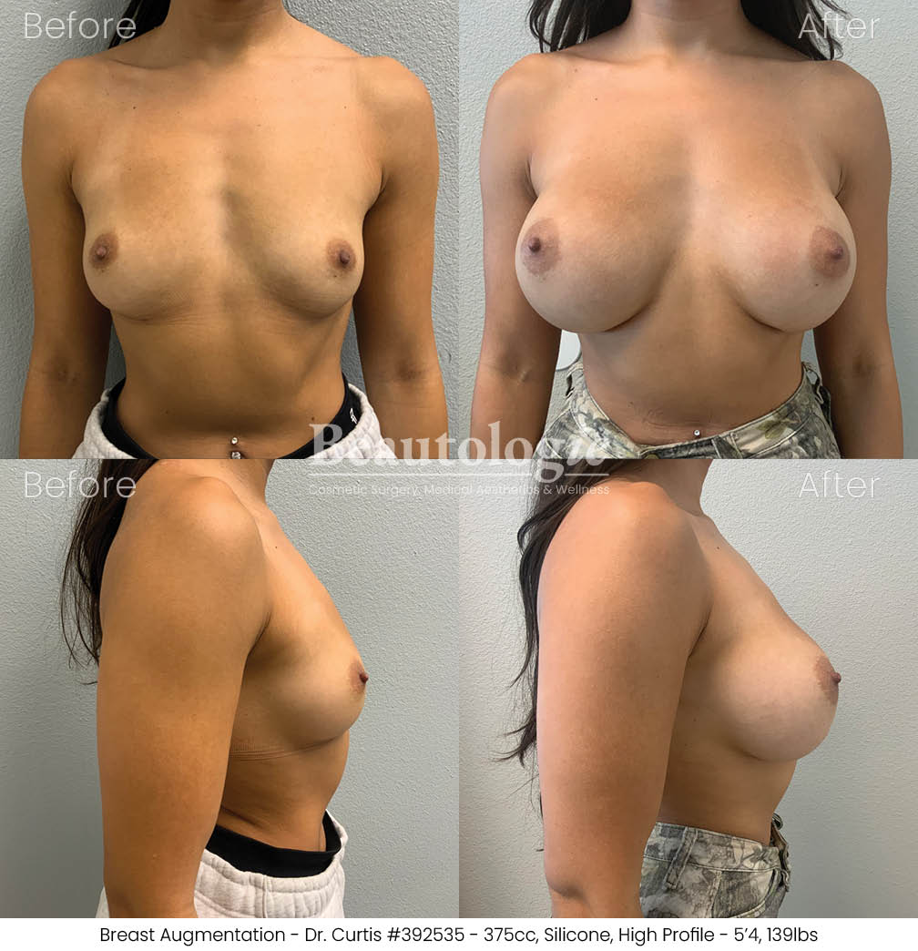 Before-and-afters-breast-breast-augmentation-dr-curtis-33