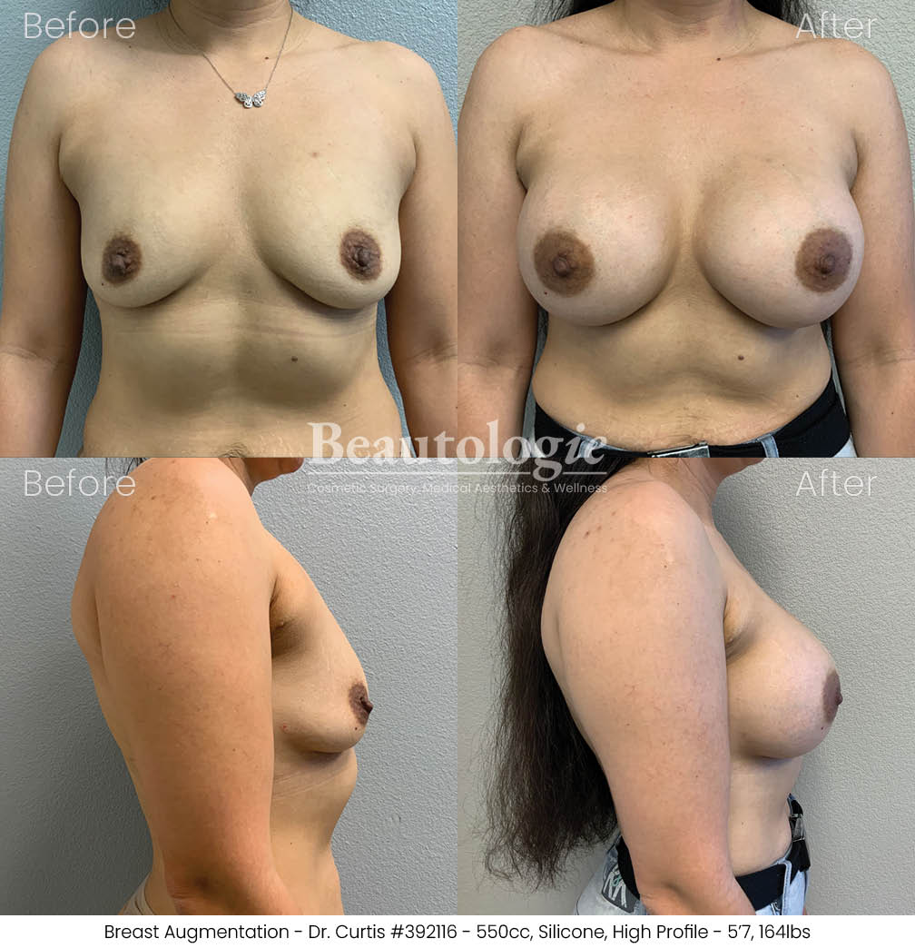 Before-and-afters-breast-breast-augmentation-dr-curtis-34
