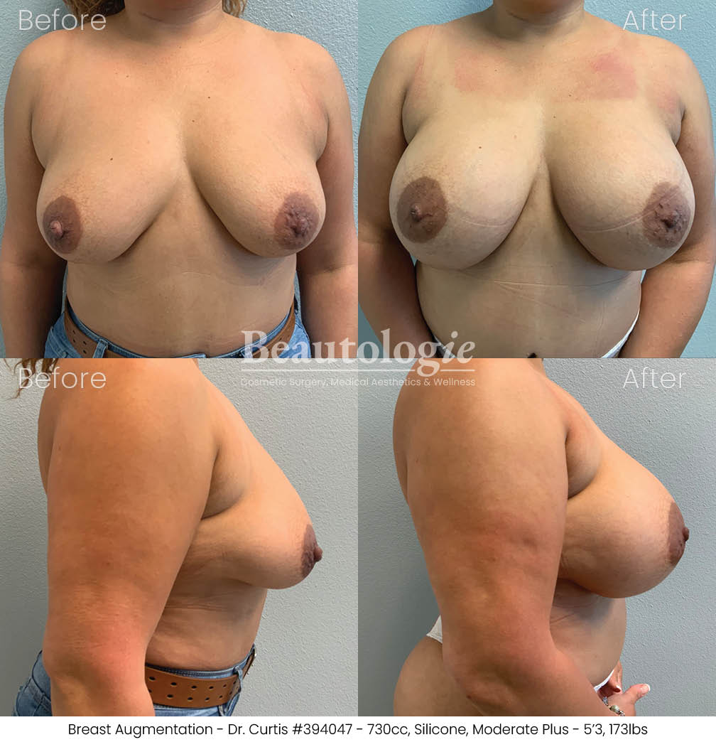 Before-and-afters-breast-breast-augmentation-dr-curtis-35