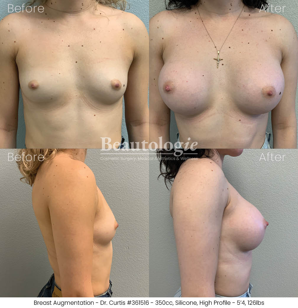 Before-and-afters-breast-breast-augmentation-dr-curtis-36