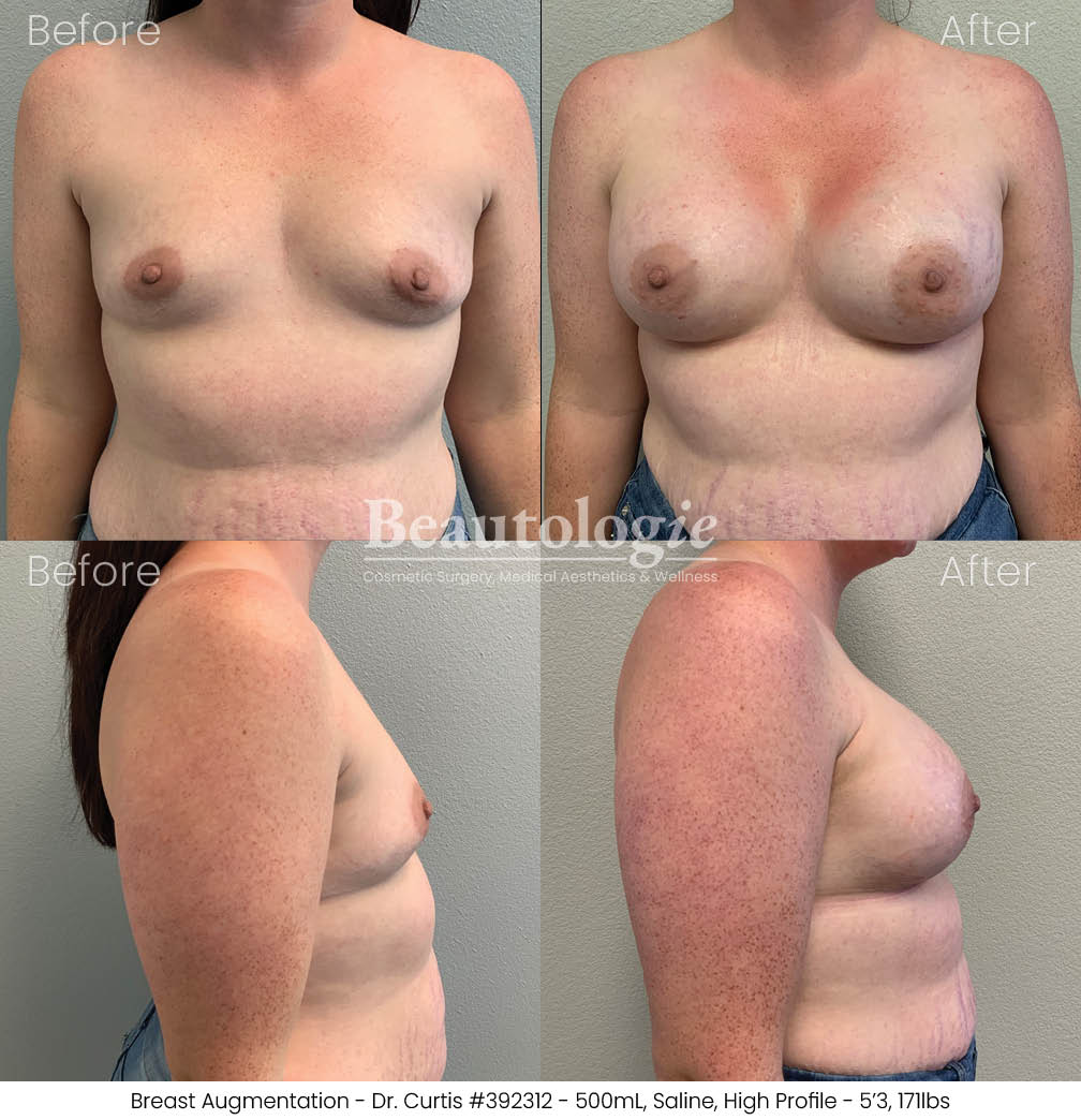 Before-and-afters-breast-breast-augmentation-dr-curtis-37