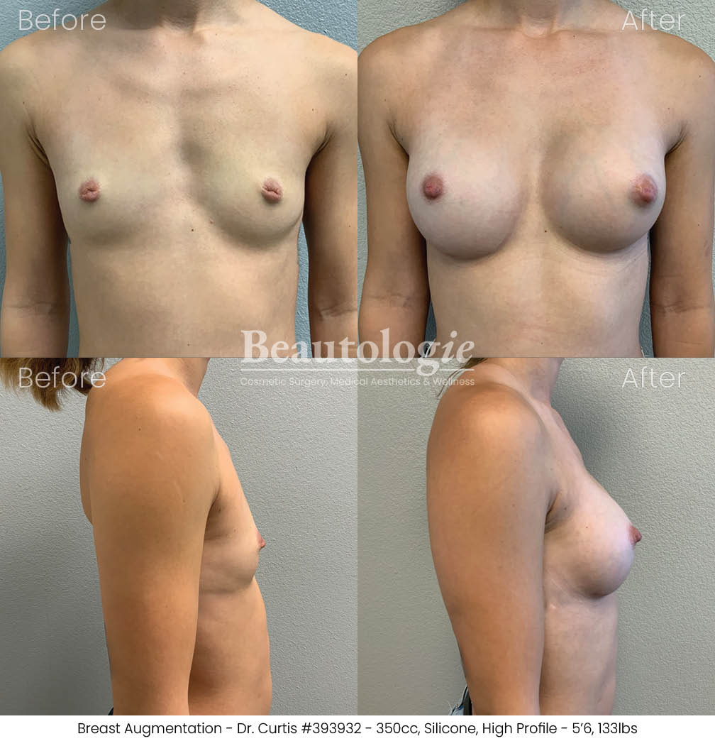 Before-and-afters-breast-breast-augmentation-dr-curtis-38