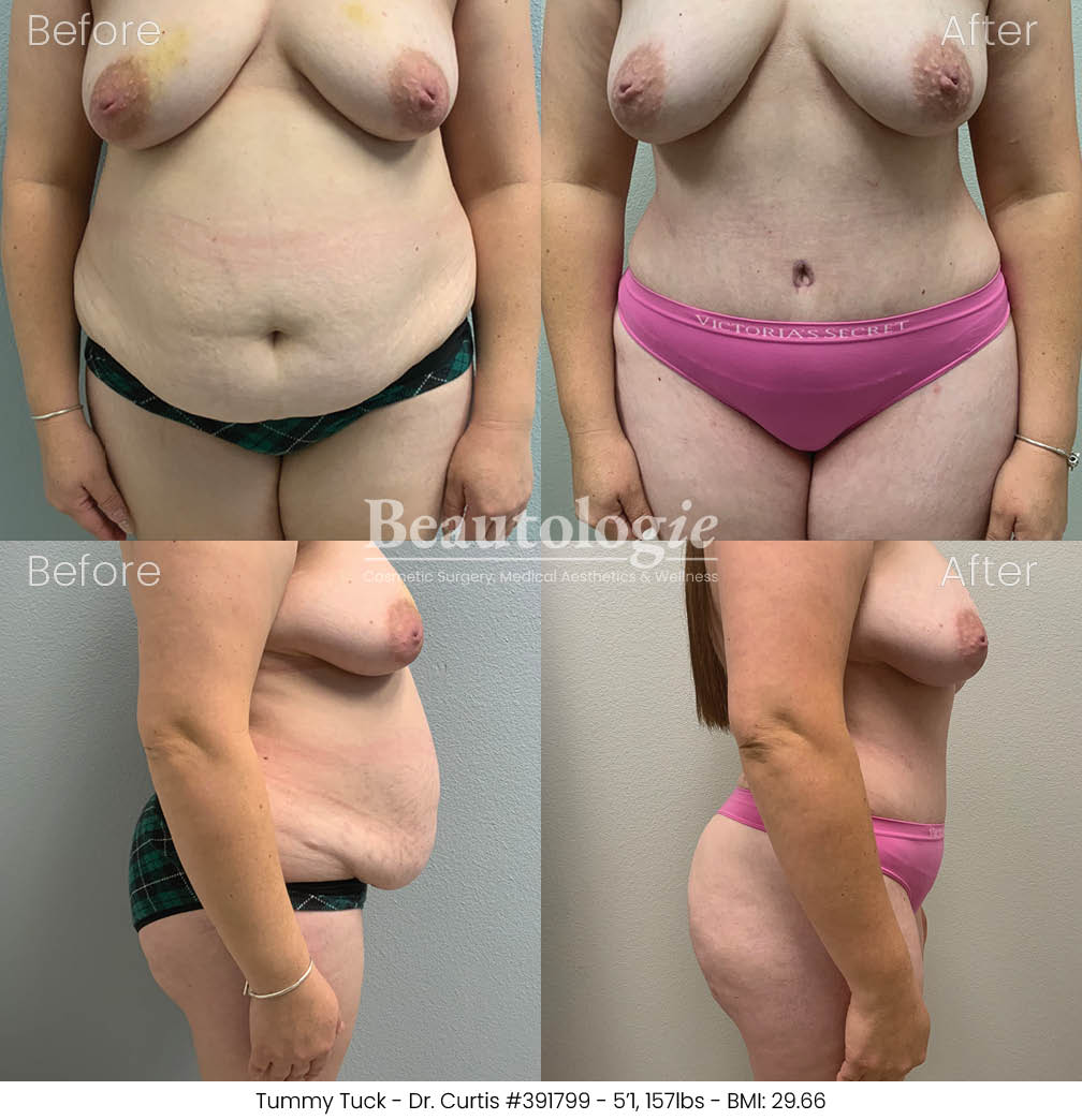 Before-and-afters-body-tummy-tuck-dr-curtis-11